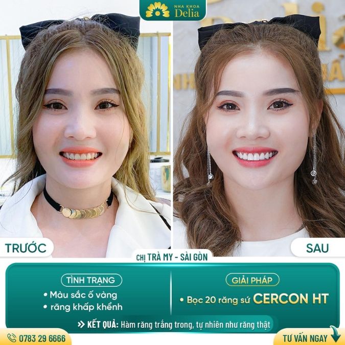 Răng sứ Cercon có mấy loại, giá bao nhiêu? Khách hàng nói gì về sứ Cercon?