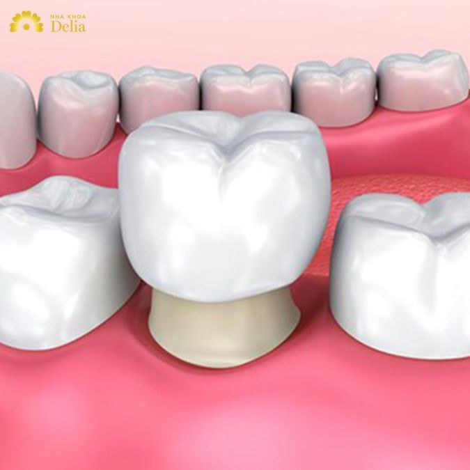 Bọc răng sứ 1 chiếc được không? Nên chọn loại sứ nào là tốt nhất?