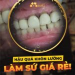 bọc răng sứ 500k