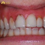 Bọc răng sứ bị đen chân răng