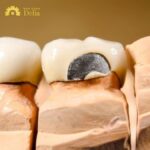 bọc răng sứ bị gãy