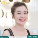 bọc răng sứ bị mỏi hàm