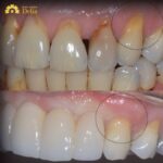 Bọc răng sứ bị tụt lợi