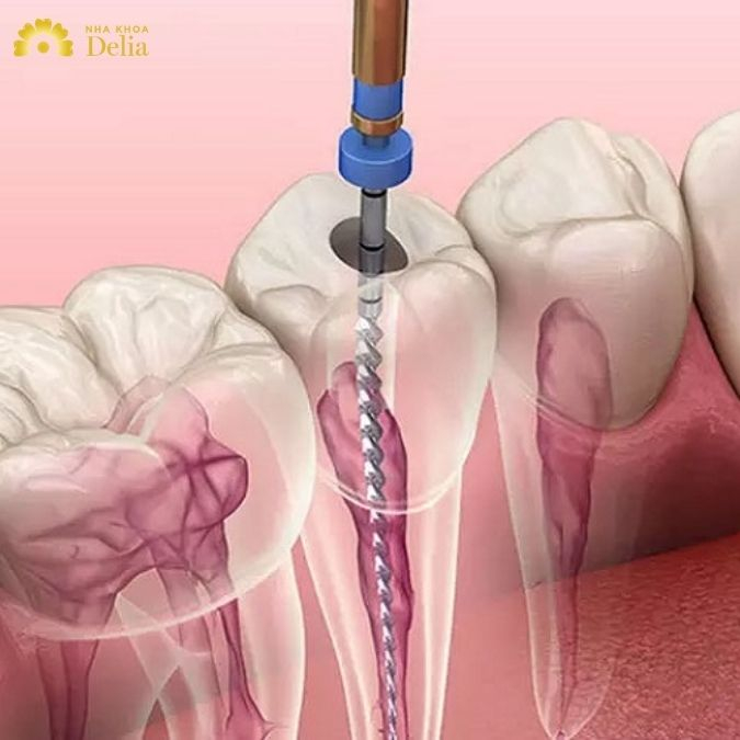 Sự thật: Bọc răng sứ có cần lấy tủy không? Lấy tủy có đau không?