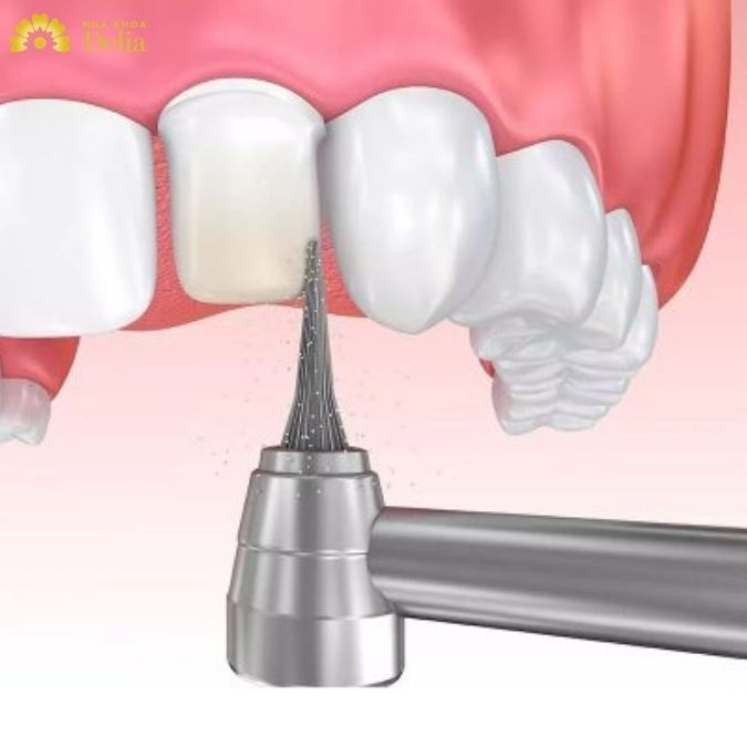 Liệu rằng bọc răng sứ có phải mài không?