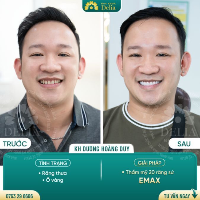 Bọc răng sứ có tác dụng gì? Khi nào nên bọc răng sứ?
