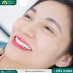 Bọc răng sứ nguyên hàm