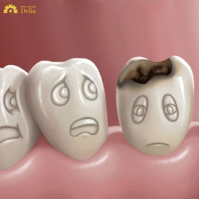 Bọc sứ răng sâu có làm được không? Nên bọc sứ hay trám răng sâu?