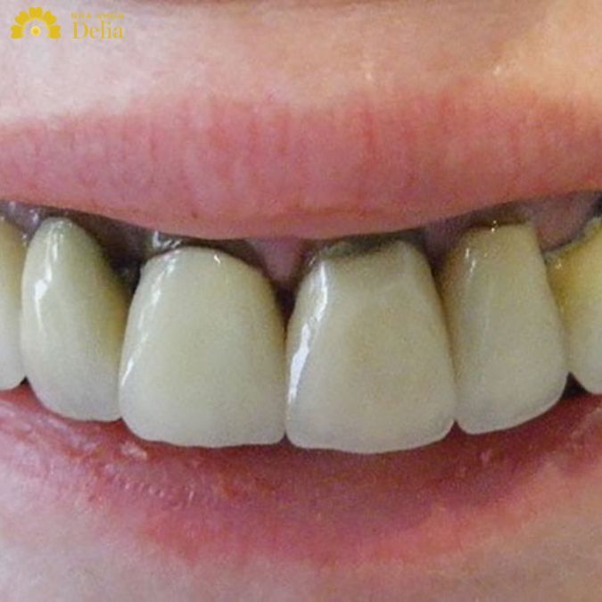 Tại sao chân răng bị đen? Cách khắc phục chân răng bị đen hiệu quả
