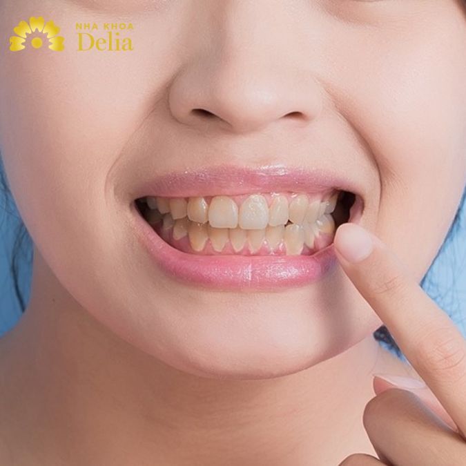 Bật mí những cách làm trắng chân răng bị vàng đơn giản và hiệu quả