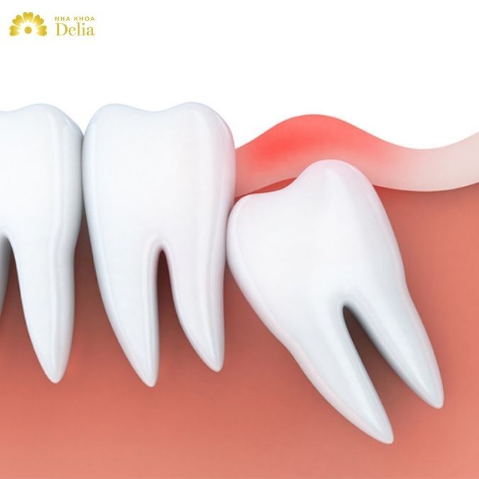 Chân răng khôn (răng số 8) có điểm gì khác biệt chân răng thường?