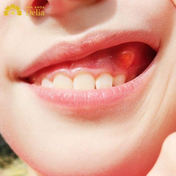 Chân răng nổi cục thịt cảnh báo bệnh gì? Có tự khỏi được không?