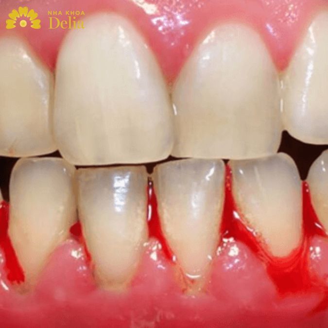 Bổ sung 5 loại vitamin cần thiết hỗ trợ cải thiện chân răng yếu