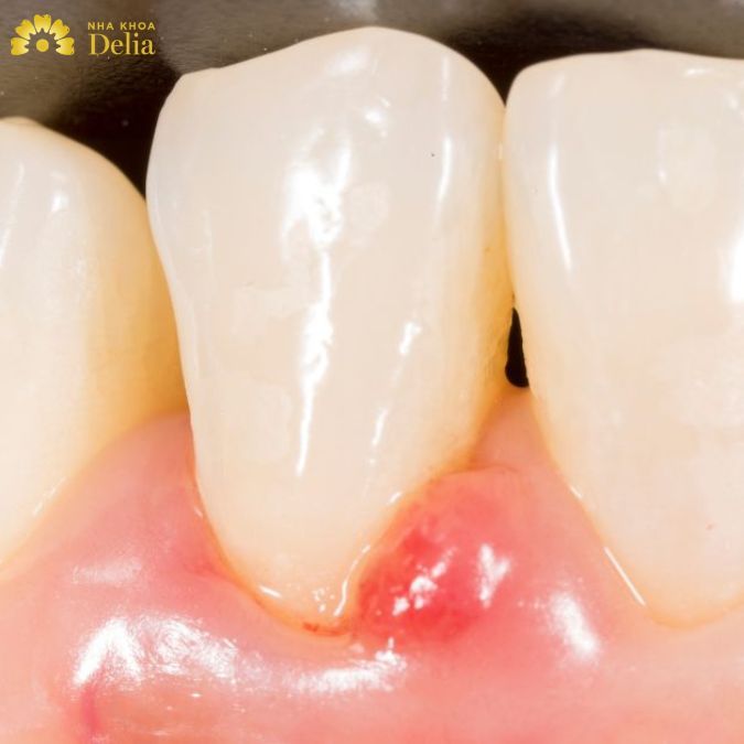 Có nên nặn mủ chân răng không? Không nặn mủ có sao không