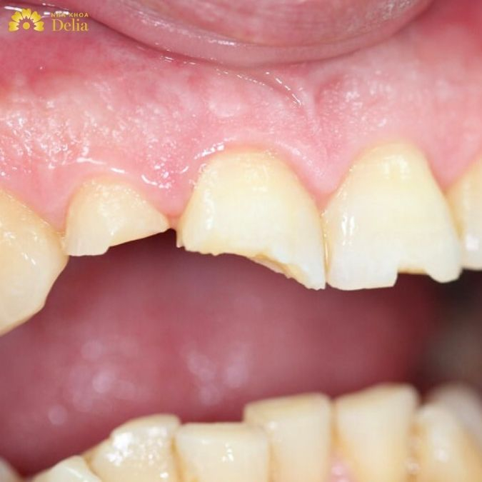 Giải đáp thắc mắc: Liệu còn chân răng có bọc răng sứ được không?