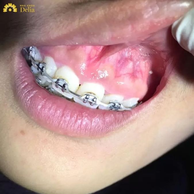 4 Dấu hiệu bật chân răng phổ biến? Nhận biết trị dứt điểm ngay