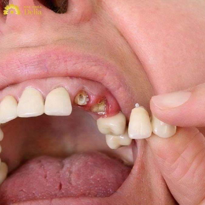 Dấu hiệu gãy chân răng khác gì so với rạn và chia chân răng?