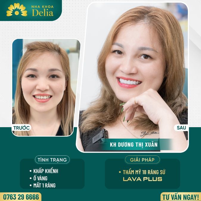 Cùng chị Xuân vượt 2000km đến Delia bọc răng sứ Lava Plus