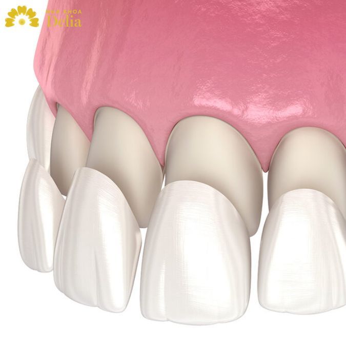 10+ Hậu quả bọc răng sứ giá rẻ mà bạn cần biết