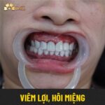 hình ảnh các bệnh về răng