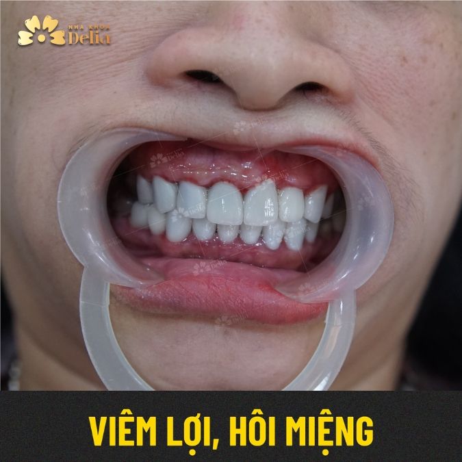 30+ Hình ảnh các bệnh về răng phổ biến thường gặp nhất