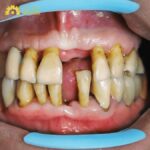 hình ảnh răng sứ hỏng