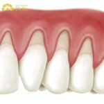 Cách chữa trị chân răng hở cổ