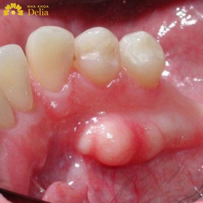 Lồi xương chân răng có nguy hiểm không? Cách điều trị nào là hiệu quả nhất?