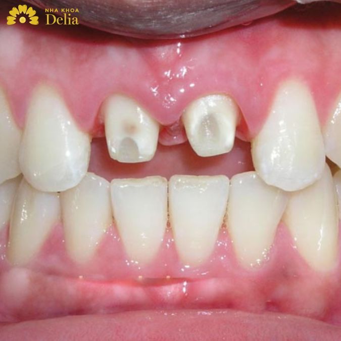 Tất tần tật từ A đến Z về mài răng sứ có thể bạn chưa biết