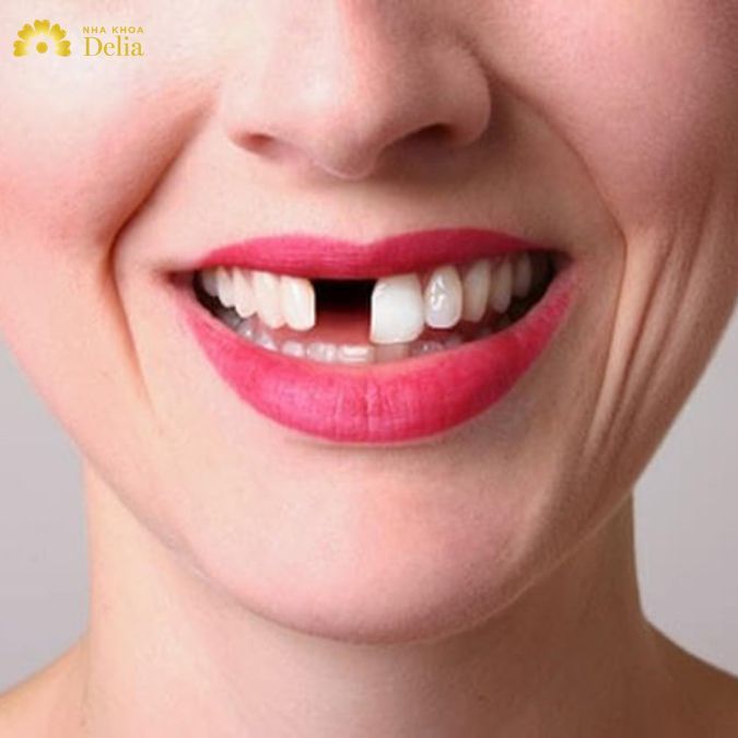 Mất răng có làm răng sứ được không? Phương pháp nào đem lại hiệu quả nhất?