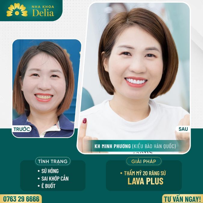 Bọc răng sứ Lava Plus loại bỏ răng sứ hỏng cùng chị Minh Phương