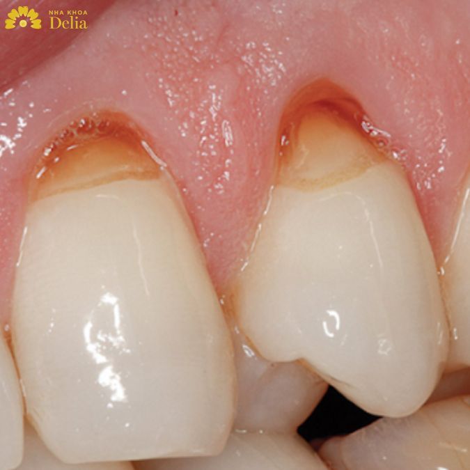 Mòn cổ chân răng: Nguyên nhân, dấu hiệu và cách khắc phục