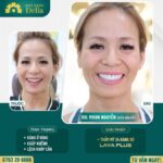 Trước và sau khi chị Moon Nguyễn thẩm mỹ răng sứ tại Delia