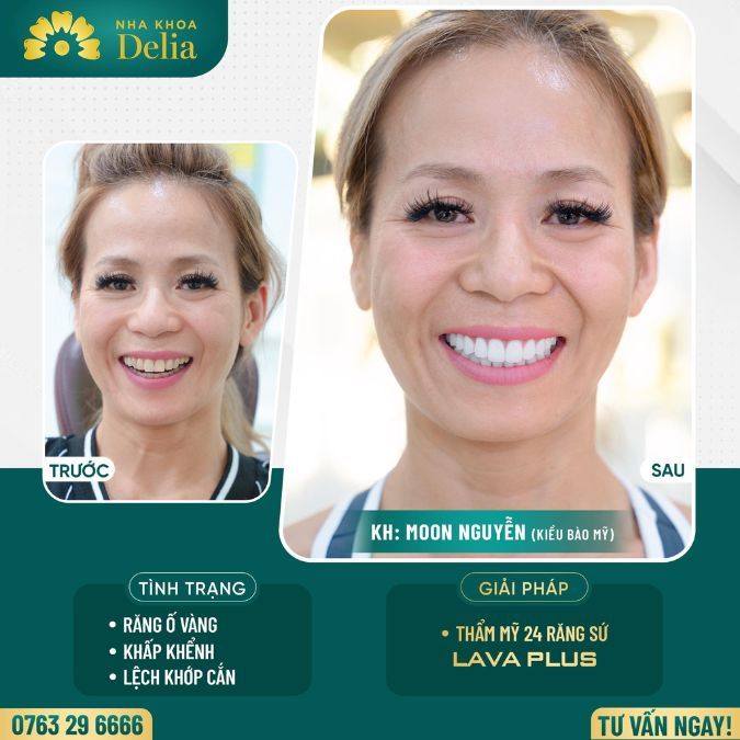 Làm răng sứ Lava Plus khắc phục khớp cắn lệch cùng chị Moon