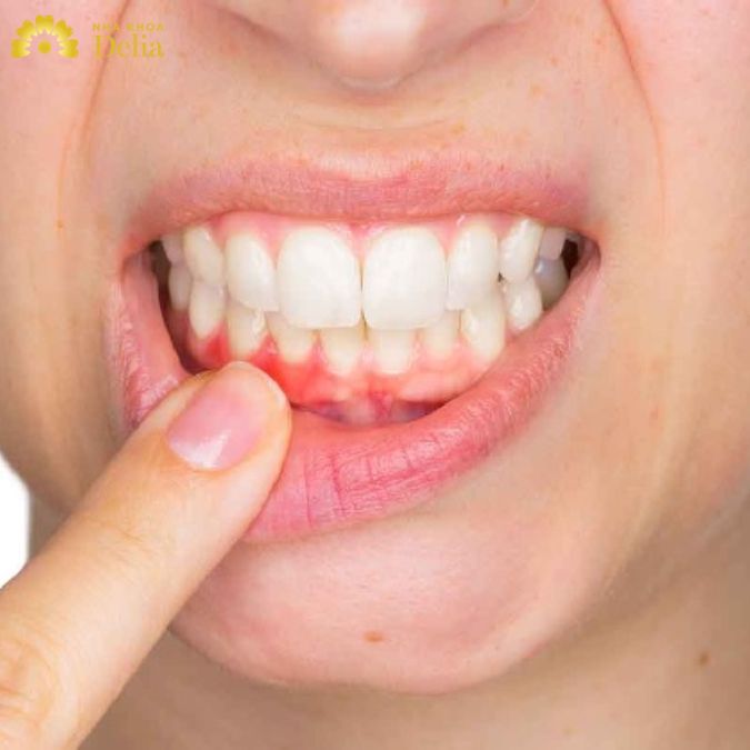 Có nên điều trị nhiễm trùng chân răng từ sớm? Nên hay không điều trị tại nhà? Phương pháp nào hiệu quả nhất?