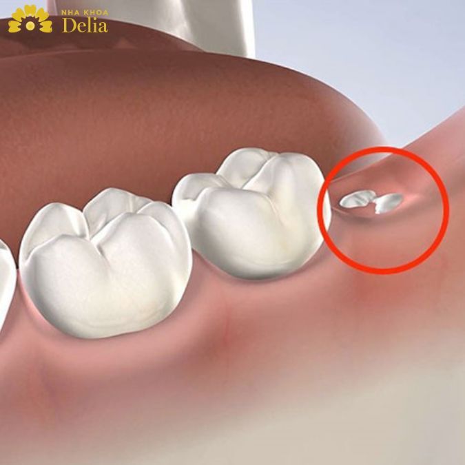 Nhổ răng còn sót chân răng có sao không? Làm sao để biết nhổ răng còn sót chân?