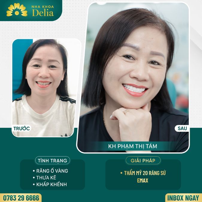 Bọc răng sứ Emax khắc phục răng thưa kẽ, khấp khểnh – Chị Tám