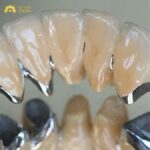 Quy trình bọc răng sứ titan