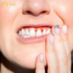 răng bọc sứ bị chảy máu