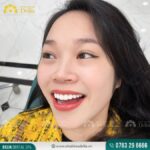 răng bọc sứ lâu năm bị đau nhức