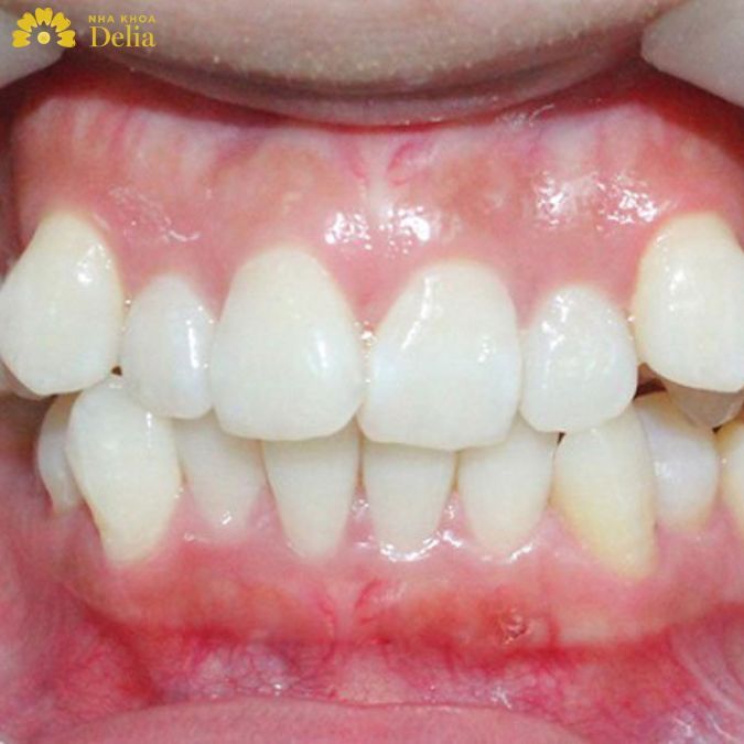 Răng khấp khểnh có làm răng sứ được không?