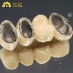 răng sứ 800k