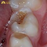 Răng sứ bị ngấm nước bọt