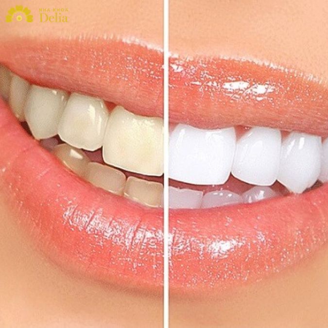 Giải đáp: Răng sứ có bị xuống màu không? Cải thiện tình trạng xỉn màu như thế nào?