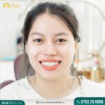 Răng sứ thỏ