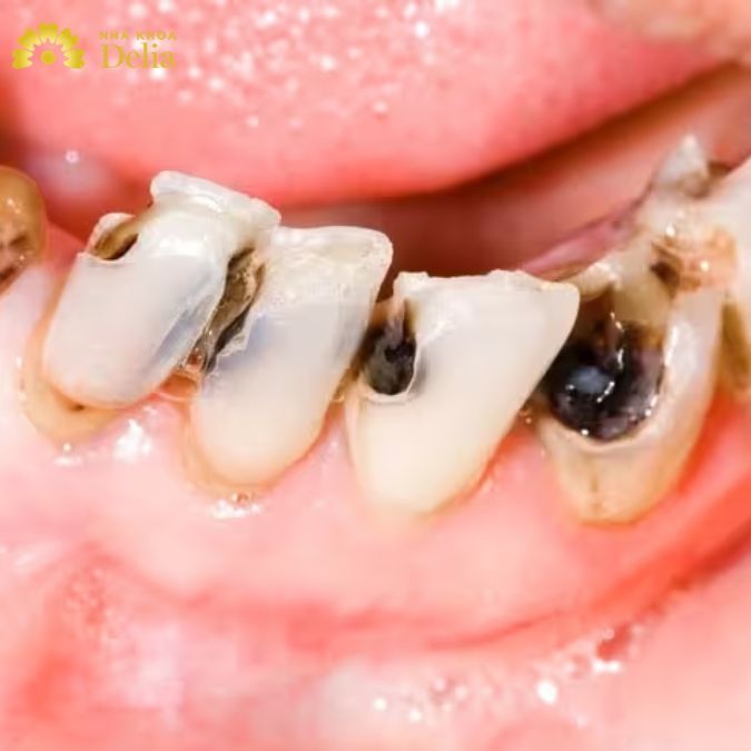 Sâu chân răng có giải quyết triệt để được không? Nên làm gì ngay