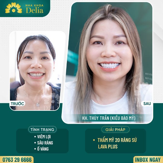 Bọc răng sứ Lava Plus loại bỏ mặc cảm tự ti – Chị Thúy chia sẻ