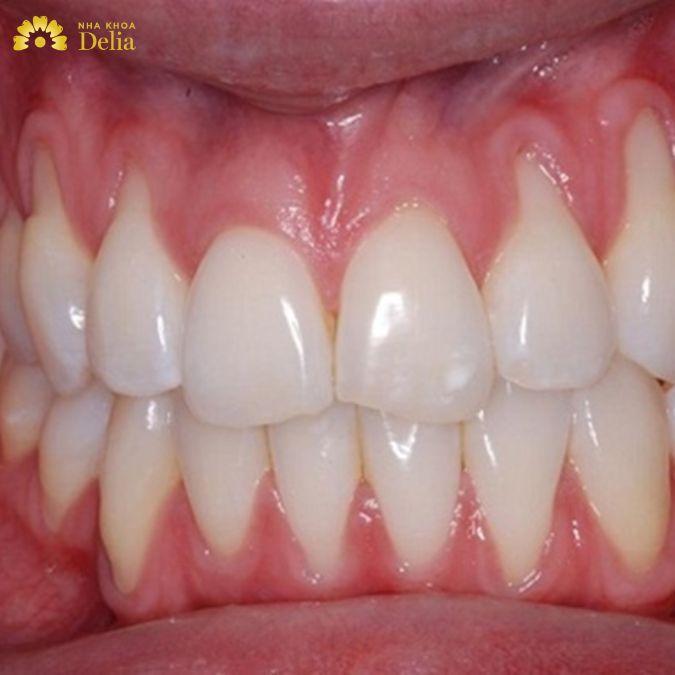 Giải đáp: Tụt lợi có nên bọc răng sứ hay không?
