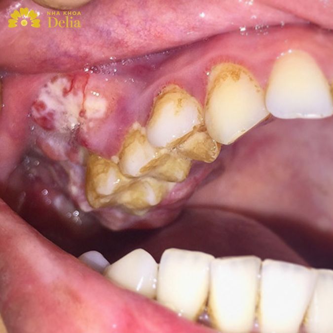Ung thư chân răng không còn đáng sợ với 7 phương pháp phòng ngừa chuẩn y khoa