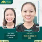 Chị Thủy trước và sau khi thẩm mỹ răng sứ tại Delia